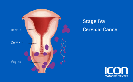 Stage 4a Cervical Cancer