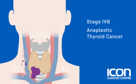 Stage 4b anaplastic thyroid cancer