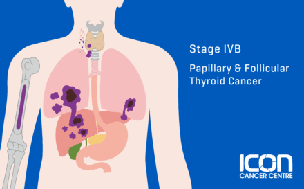 Stage 4b papillary and follicular thyroid cancer
