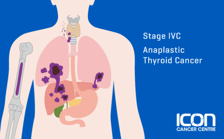 Stage 4c anaplastic thyroid cancer