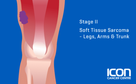 Stage 2 soft tissue sarcoma in the arms, legs and trunk