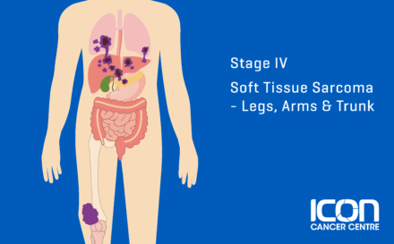 Stage 4 soft tissue sarcoma