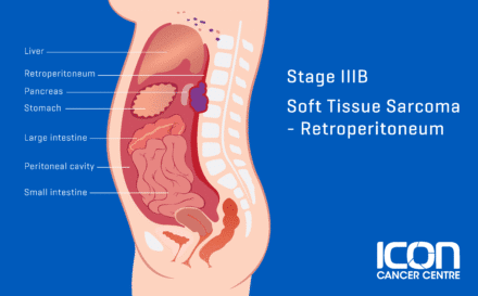 Stage 3b soft tissue sarcoma retroperitoneum