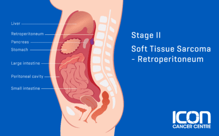 Stage 2 soft tissue sarcoma retroperitoneum