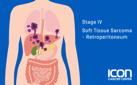 Stage 4 soft tissue sarcoma retroperitoneum